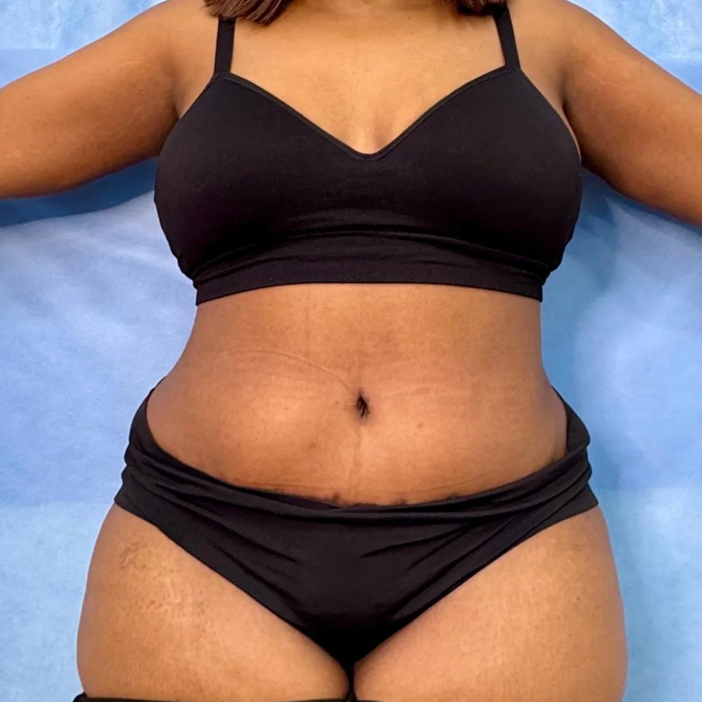 Extended Abdominoplasty After